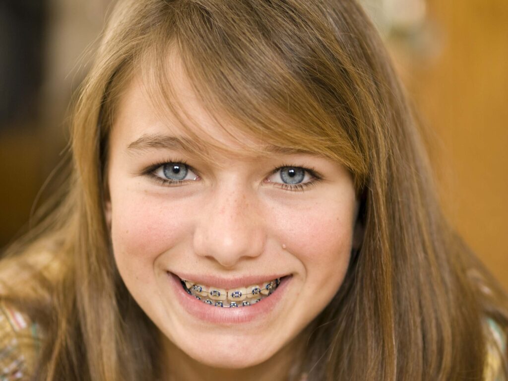 5 Signs That You Need Braces